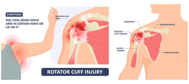 Medical illustration of Rotator Cuff injury