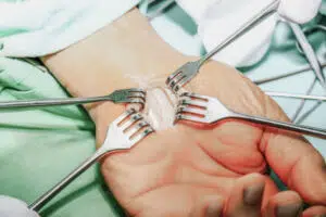 Adult male carpal tunnel hand surgery in hospital