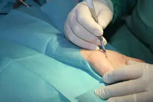 Surgeon operates carpal tunnel syndrome