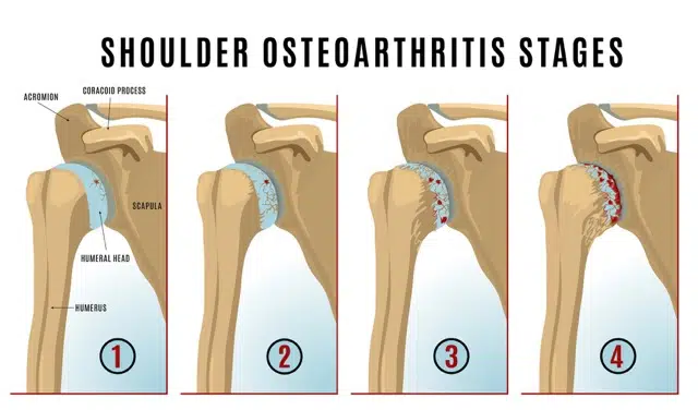 medical illustration of shoulder Osteoarthritis