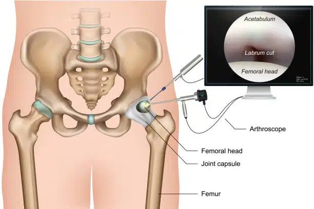 Hip arthroscopy 3d medical illustration