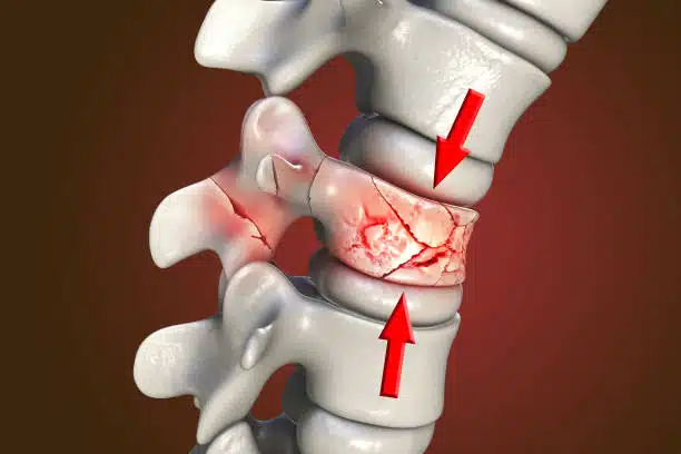 Spinal fracture, traumatic vertebral injury, 3D illustration. Compression fracture of the spine