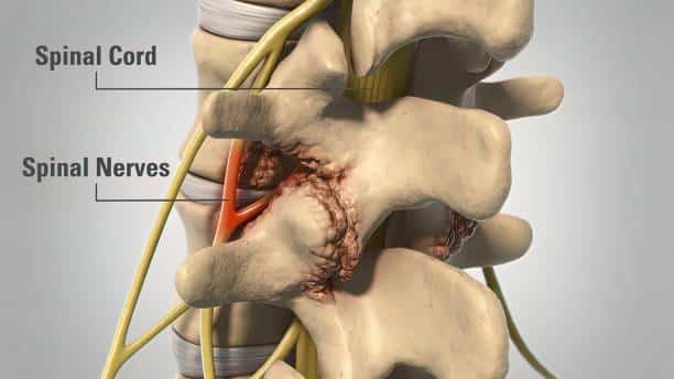 Backbone Laminectomy Degenerative Dics Disease 3D illustration