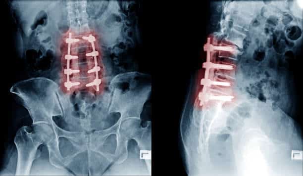 Shoulder Pain After Neck Fusion Surgery