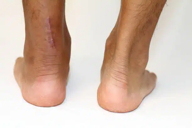 image of a patients feet after an operation of Achilles tendon rupture