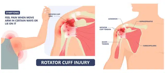 Medical illustration of Rotator Cuff Injury concept 