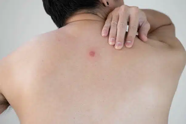 The back of mature Asian man with red abscesses