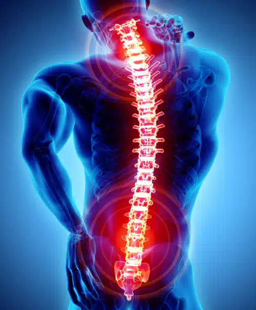 3D illustration of a human with a spinal disorder 