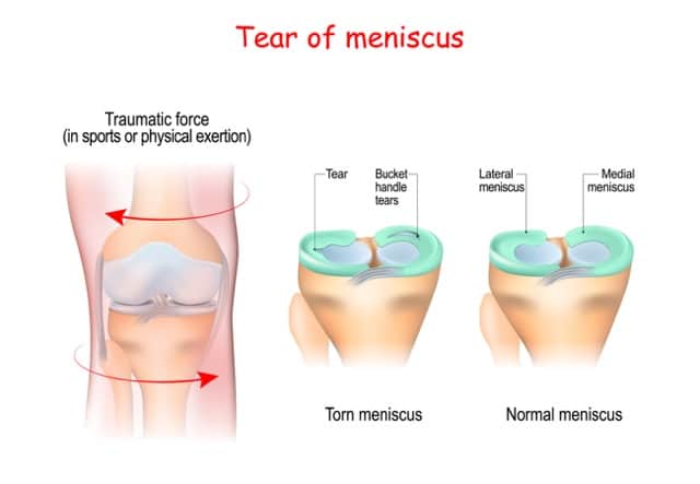 Medical illustration of knee with Meniscus Repair