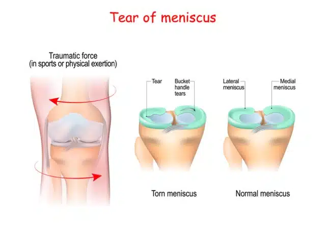 Medical illustration of knee with Meniscus Repair