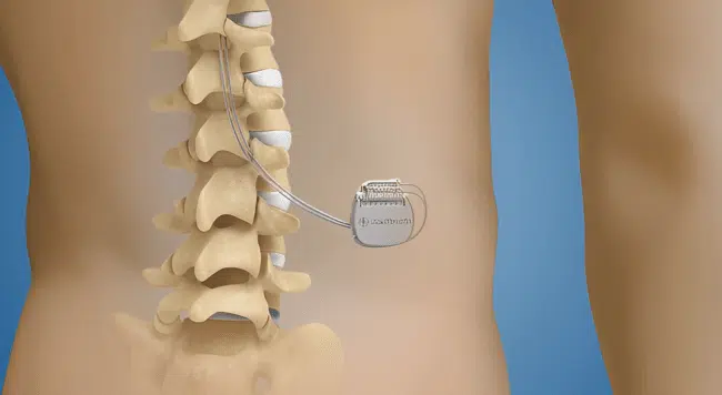 3D medical illustration of a human body under going Spinal Cord Stimulation treatment.