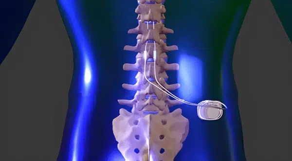 3D medical illustration of a human body under going Spinal Cord Stimulation treatment.