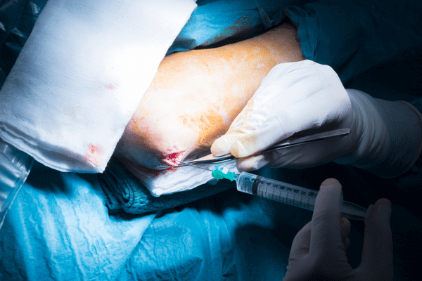 Ulnar Nerve Decompression Surgery