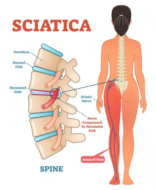 Medical Illustration of a woman having Sciatica.
