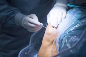 Surgeons performing knee surgery to the patient inside the operating room.