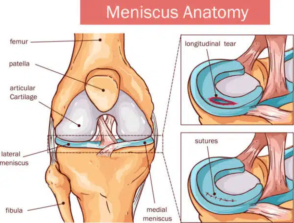 Medical illustration of tear meniscus.