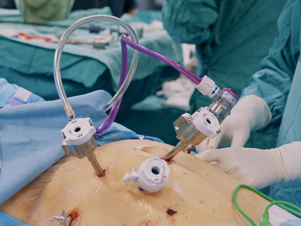 Team of Surgeon doing Laparoscopic Cholecystectomy Surgery inside the operating room.