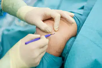 Surgeon marking patients elbow before surgery